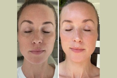 Comparing Results from the Best Aesthetic Clinic in dubai Fotona 4D Laser