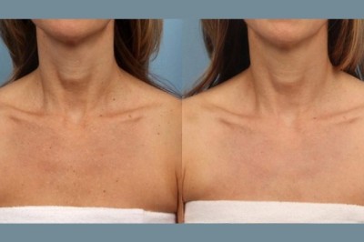 Why the Best Aesthetic Clinic in dubai Recommends Moxi Laser Treatment