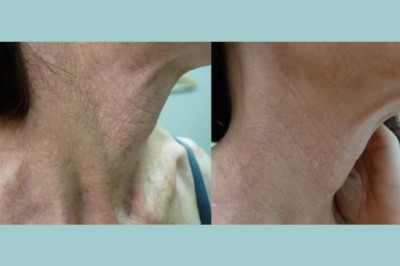 Step-by-step guide to Fotona 4D Laser best doctors in Dubai