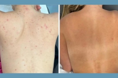 Trusted Results from Moxi Laser Treatment Best doctors in Dubai