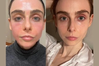 Expert Picks: Radiofrequency (RF) Microneedling doctors in Dubai