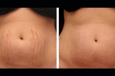 Skin Repair Excellence Using Radiofrequency (RF) Microneedling by the Best Aesthetic Clinic in dubai