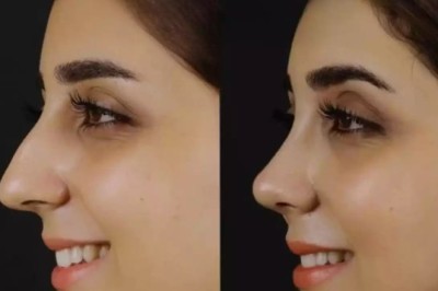 Septoplasty in Dubai with Proven Surgical Outcomes