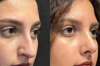 Rhinoplasty in Dubai for Functional and Cosmetic Goals