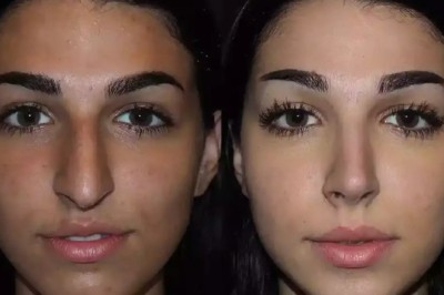 Septoplasty in Dubai Improving Airway Health