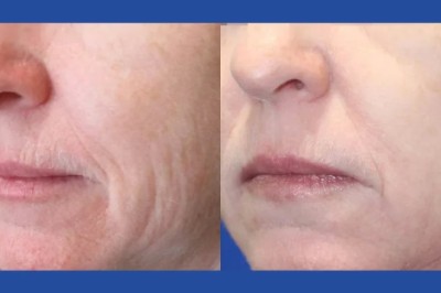 Best Doctors in Dubai for Fractional Radiofrequency (RF) Microneedling Skin Rejuvenation