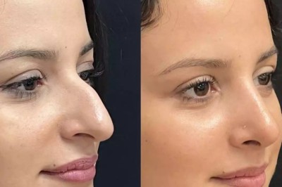 Best Doctors in Dubai and Airway-Focused Septoplasty