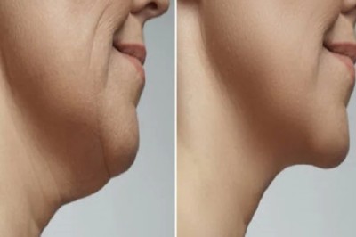 Advanced Jawline Definition with Belkyra in Dubai | Glamorous Clinic in Dubai