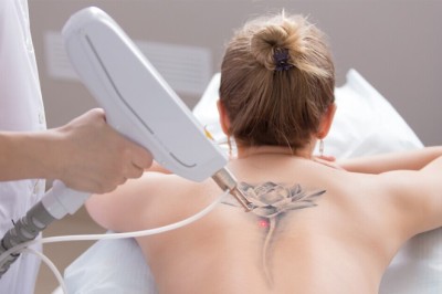 What is Laser Tattoo Removal Treatment And How Does it Work?