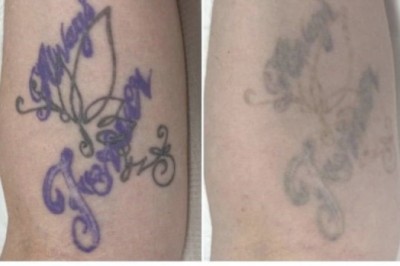 Tattoo Removal Sydney: Top Methods & What to Expect