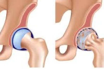 Osteoarthritis vs. Rheumatoid Arthritis: Key Differences & Treatment