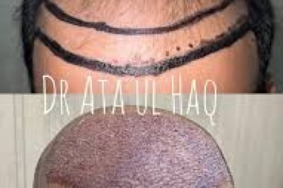 Hair Club Lahore: A Trusted Name in Hair Restoration