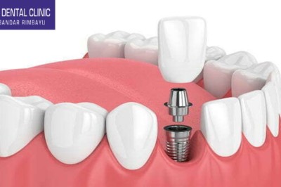 Invisible Braces: An Innovative Approach