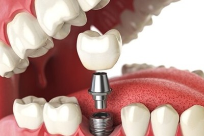 5 Common Myths About Dental Implants Debunked by a Top Implantologist in Dubai