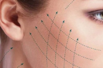 What to Expect From A Thread Lift in Barcelona: A Step-by-Step Guide For First-Timers