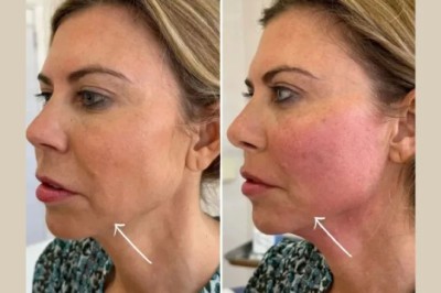 Best Aesthetic Clinics in dubai for Anti-Aging Treatments Like Endolift