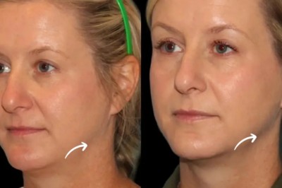 Best Aesthetic Clinics in Dubai: Sculptra Regimen Plan