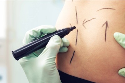 What Best Liposuction Surgeon in Dubai Want You to Know Before Surgery