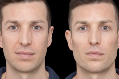 How the Best Plastic Surgeons in Dubai Achieve Symmetry in Jawline Fillers