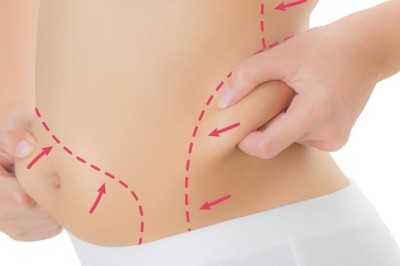 Liposuction Surgery in Dubai Trusted Advice from Best Doctors