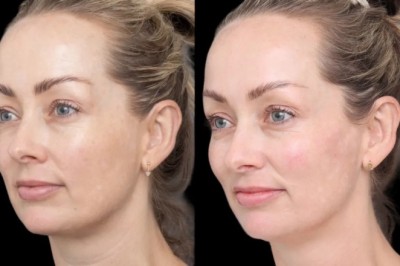 Cheek Fillers with the Best Doctors in Dubai Sculpting Your Ideal Look