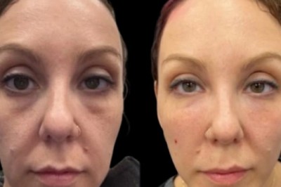 How Long Do Results Last After Dark Circles Treatment in Dubai