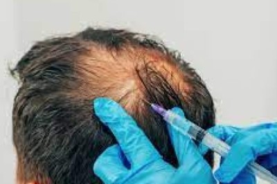 The Science Behind PRP Hair Therapy and Why It Works