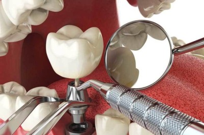 How Permanent Tooth Solutions Improve Smiles and Daily Life