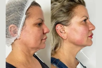 Best Aesthetic Clinics in Dubai Offering PRP Injections