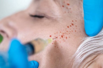 Frequently Asked Questions About PRP Treatment Dubai