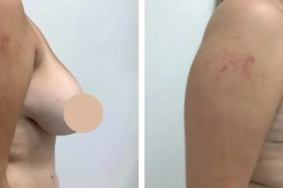 Expert Recovery Tips After Breast Lift in Dubai