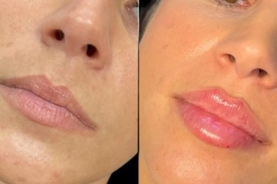 Safe & Trusted Dermal Fillers with the Best Doctors in Dubai