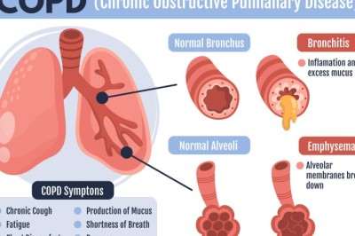 What are the 4 stages of COPD?