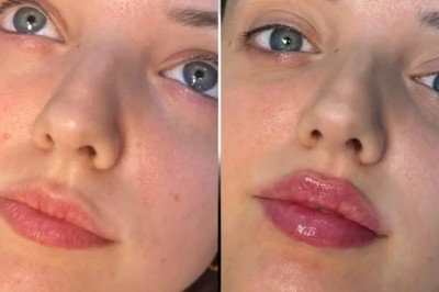 Celebrity Fillers Trends Insights from Best Plastic Surgeons in Dubai