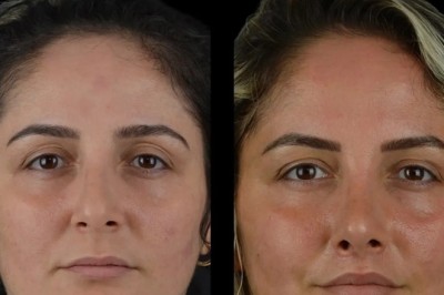 Why Cheek Fillers Are Popular with the Best Plastic Surgeons in Dubai