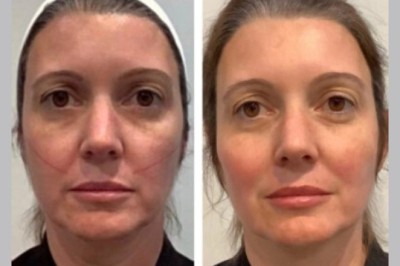 Choose Best Plastic Surgeons in Dubai For Reliable Long Lasting Thread Lift Anti Aging Treatments