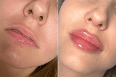 Juvederm for Hand Rejuvenation: Insights from Best Doctors in Dubai