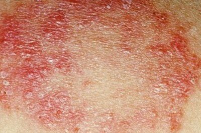 What Are the Symptoms of Bacterial Skin Infections?