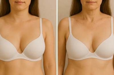 What to Expect from Breast Fat Transfer in Dubai