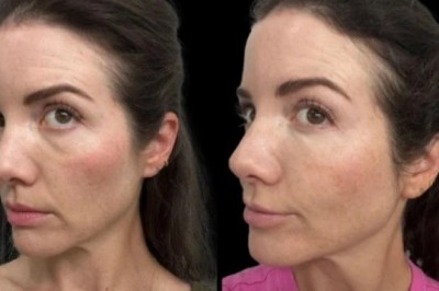 Natural-Looking Results from Non-Surgical Dark Circles Treatment in Dubai