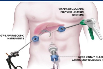 The Impact of Ambulatory Surgical Centers on the MIS Instruments Market