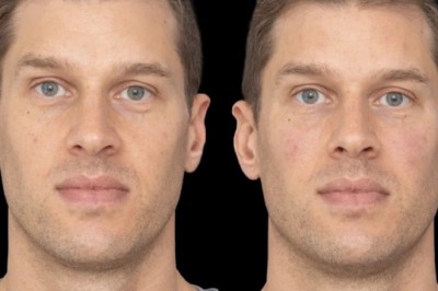 Reducing Fine Lines with Under Eye Fillers at Best Aesthetic Clinics in Dubai