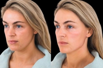 The Most Popular Cheek Fillers Available at the Best Aesthetic Clinics in Dubai