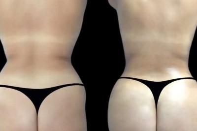 Best Plastic Surgeons in dubai Explain Hyacorp Fillers Longevity