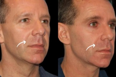 Best Aesthetic Clinics in Dubai: Sculptra Deep Injection Tips