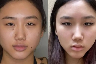 Buccal fat removal Surgery in Dubai: Before and After Photos You Must See