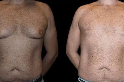 Post-Op Care Tips After Gynecomastia in Dubai