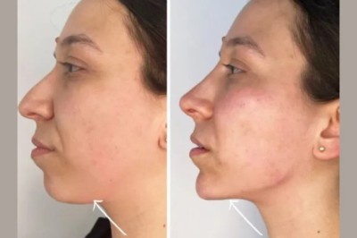 The Best Plastic Surgeons in Dubai Offer Cutting-Edge Endolift Treatments