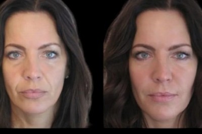 Best Plastic Surgeon in Dubai for Jawline Fillers Define Your Features with Precision