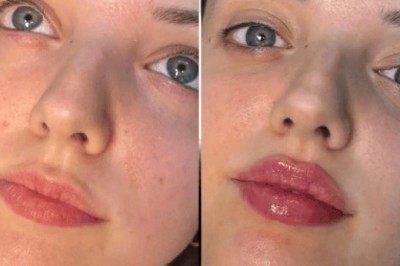 Best Plastic Surgeon in dubai for Volume Restoration Fillers